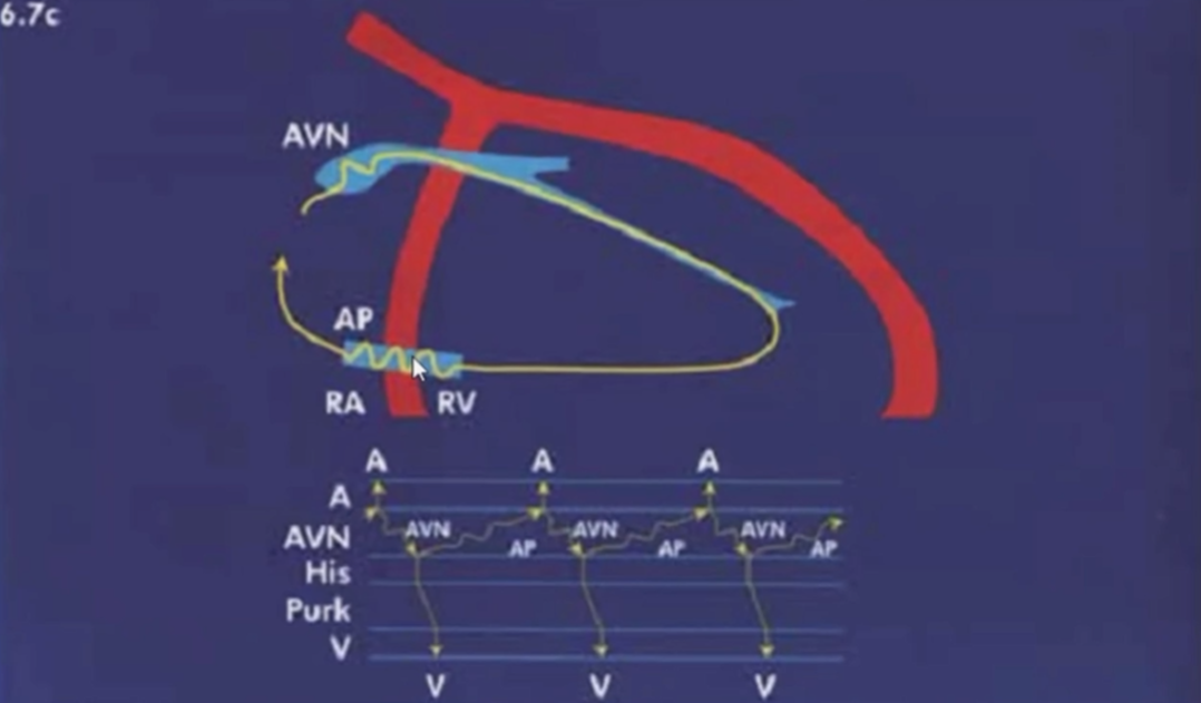心律解码丨室上性心动过速诊断与治疗，一文详解！
