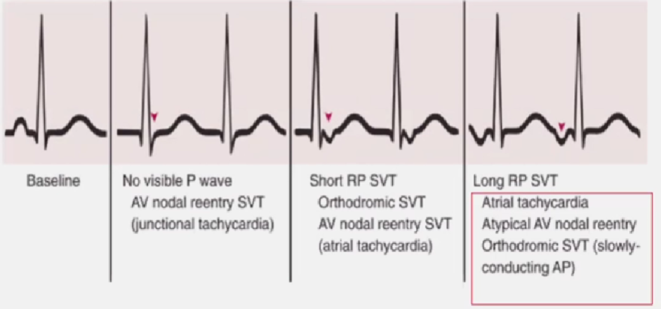 心律解码丨室上性心动过速诊断与治疗，一文详解！