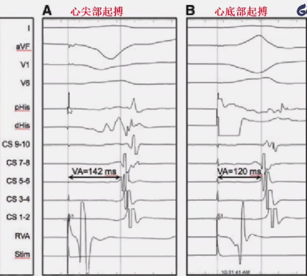 心律解码丨室上性心动过速诊断与治疗，一文详解！