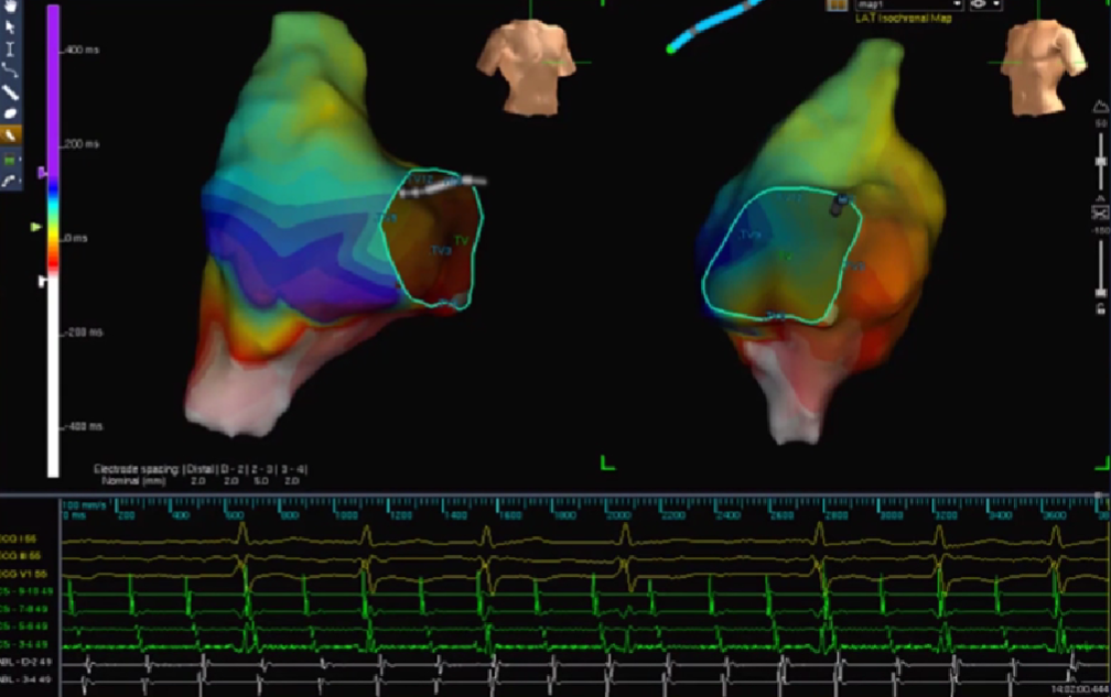 心律失常的诊断与治疗，太全了