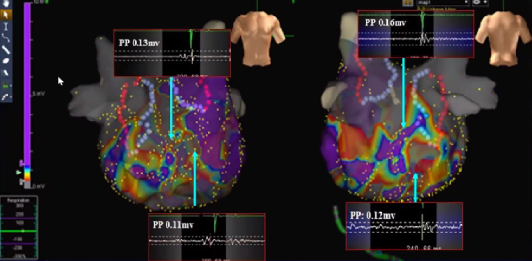 心律失常的诊断与治疗，太全了