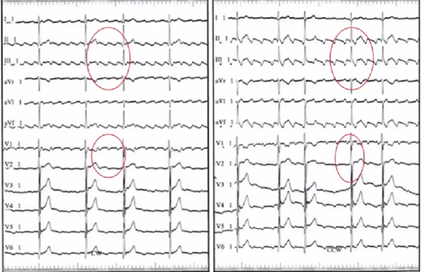 心律失常的诊断与治疗，太全了