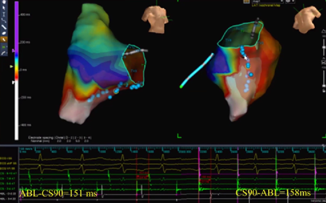 心律失常的诊断与治疗，太全了