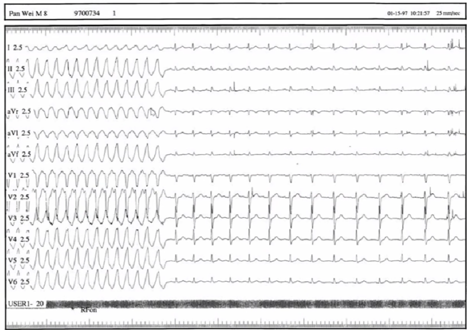 心律失常的诊断与治疗，太全了
