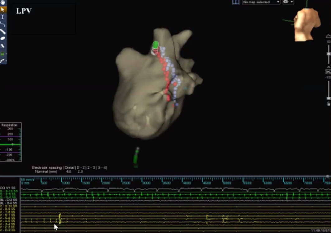 心律失常的诊断与治疗，太全了