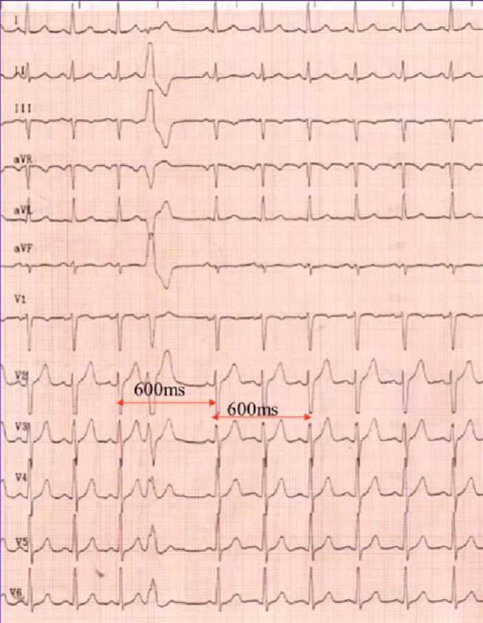 心律失常的诊断与治疗，太全了