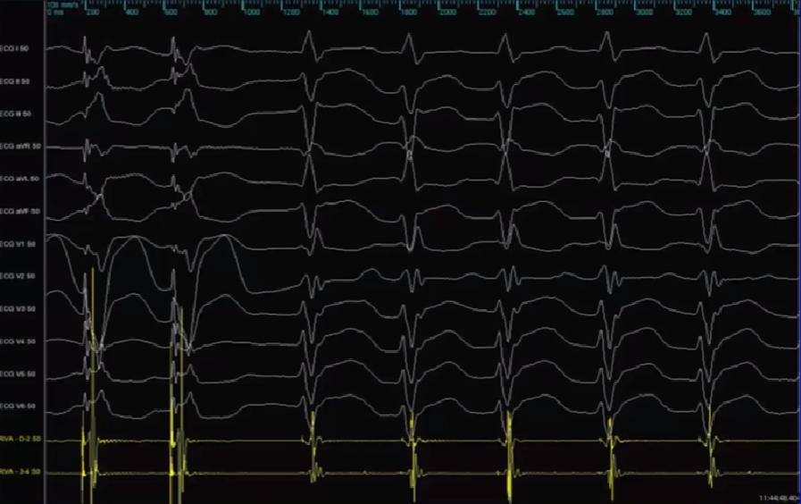 心律失常的诊断与治疗，太全了