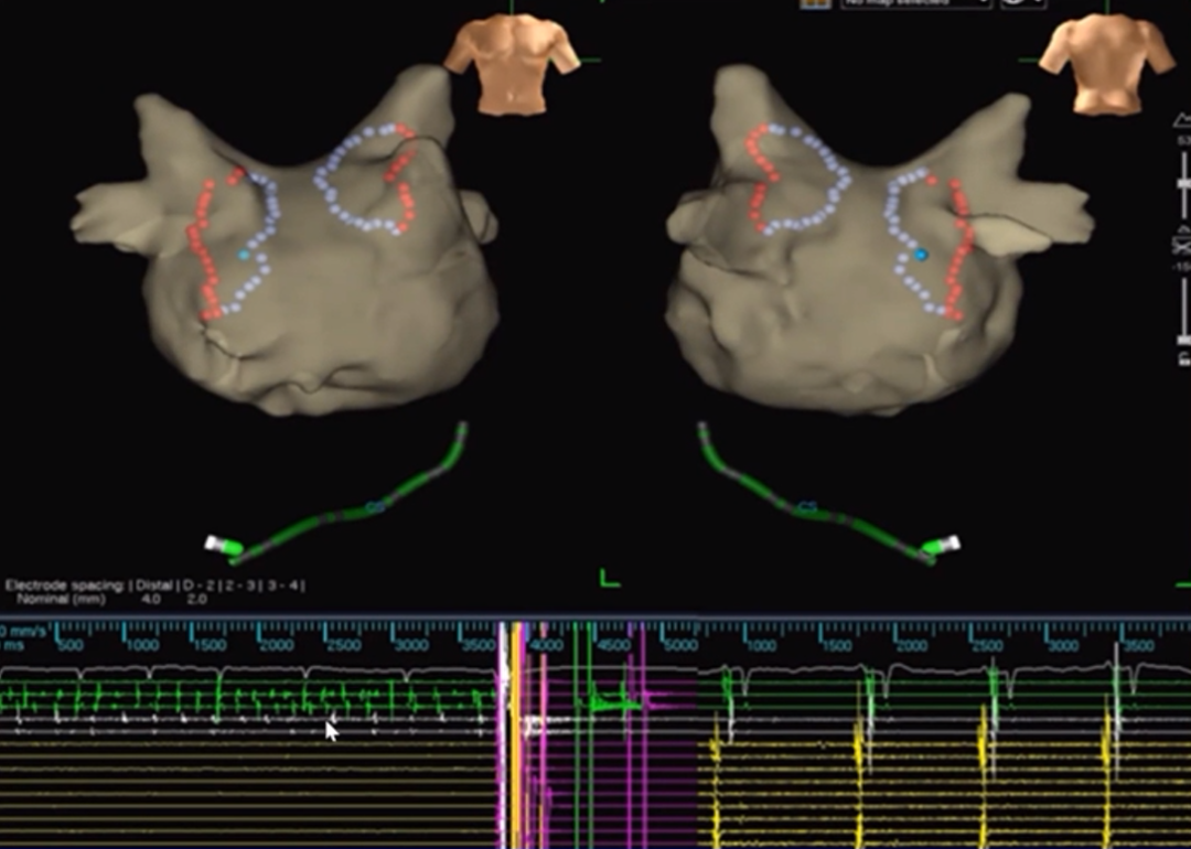 心律失常的诊断与治疗，太全了