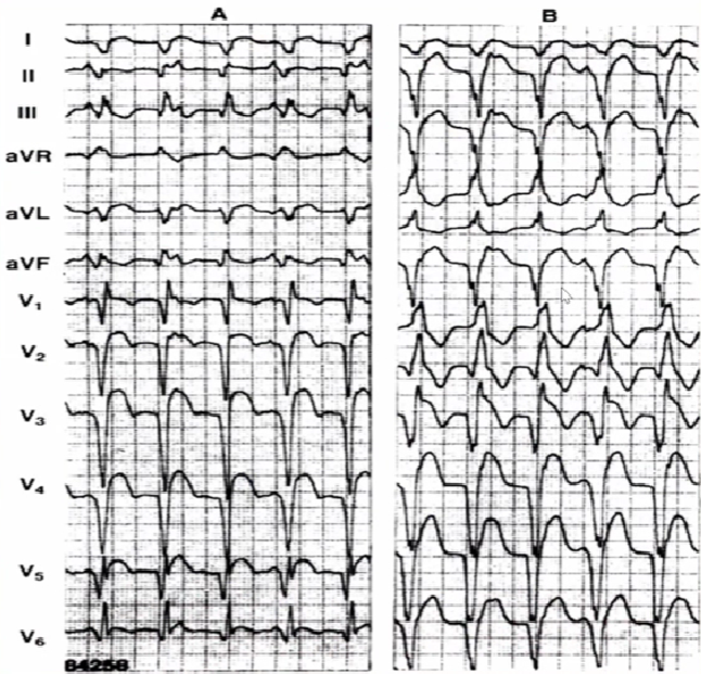 心律失常的诊断与治疗，太全了