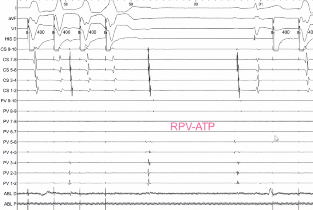 心律失常的诊断与治疗，太全了