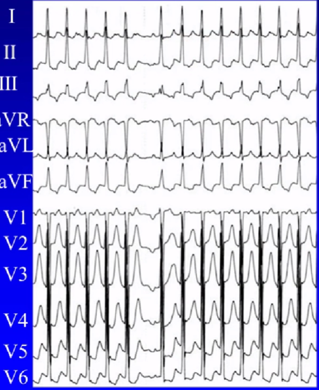 心律失常的诊断与治疗，太全了