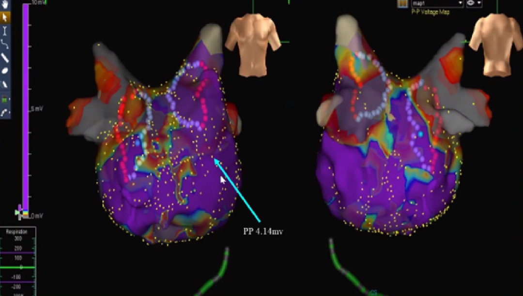 心律失常的诊断与治疗，太全了