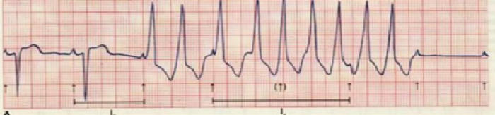 心律失常的诊断与治疗，太全了