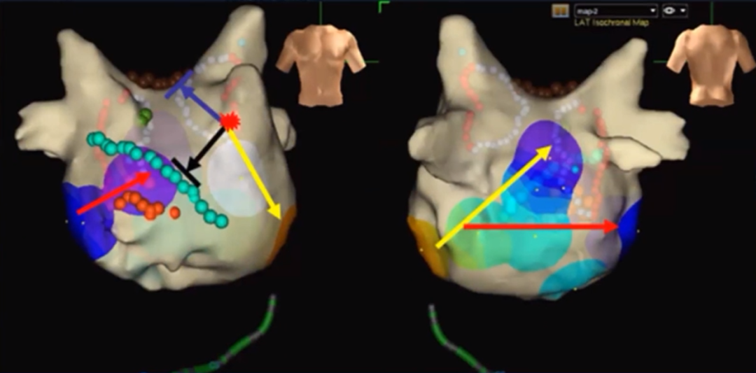 心律失常的诊断与治疗，太全了