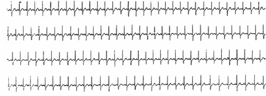 心律失常的诊断与治疗，太全了