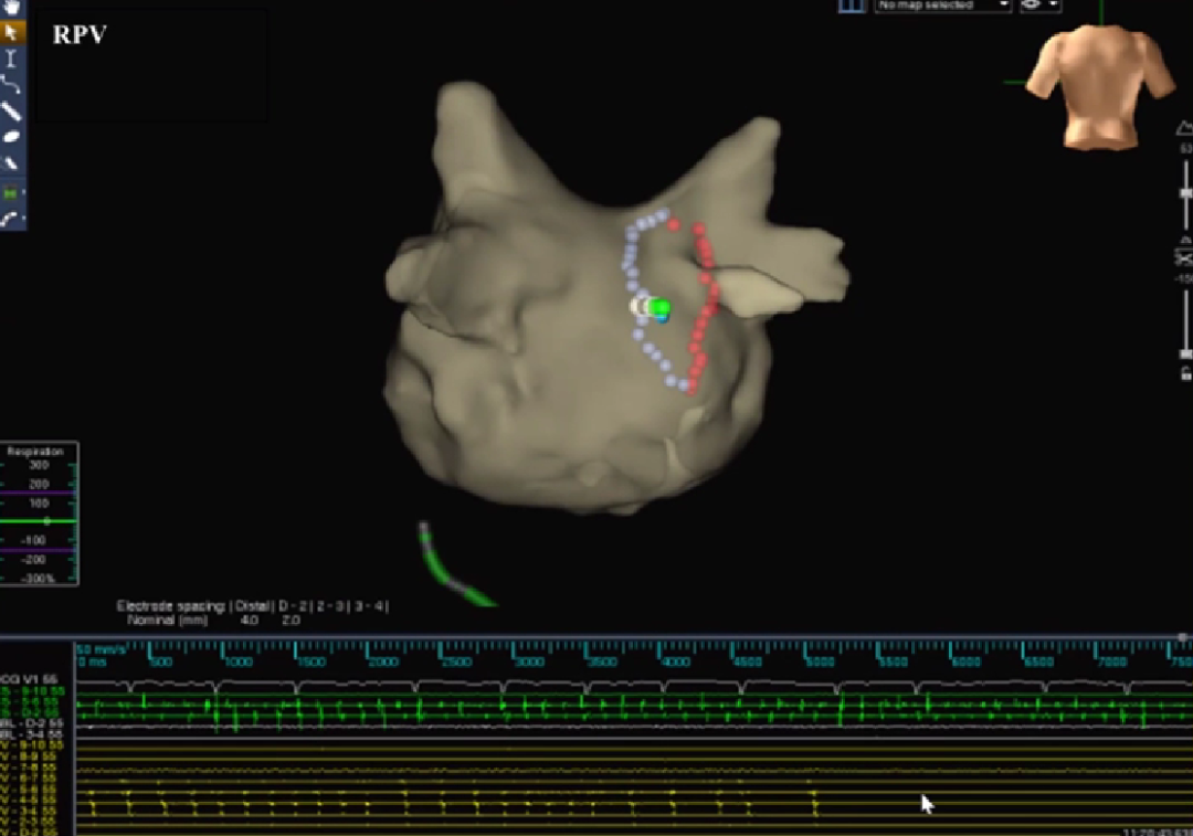 心律失常的诊断与治疗，太全了