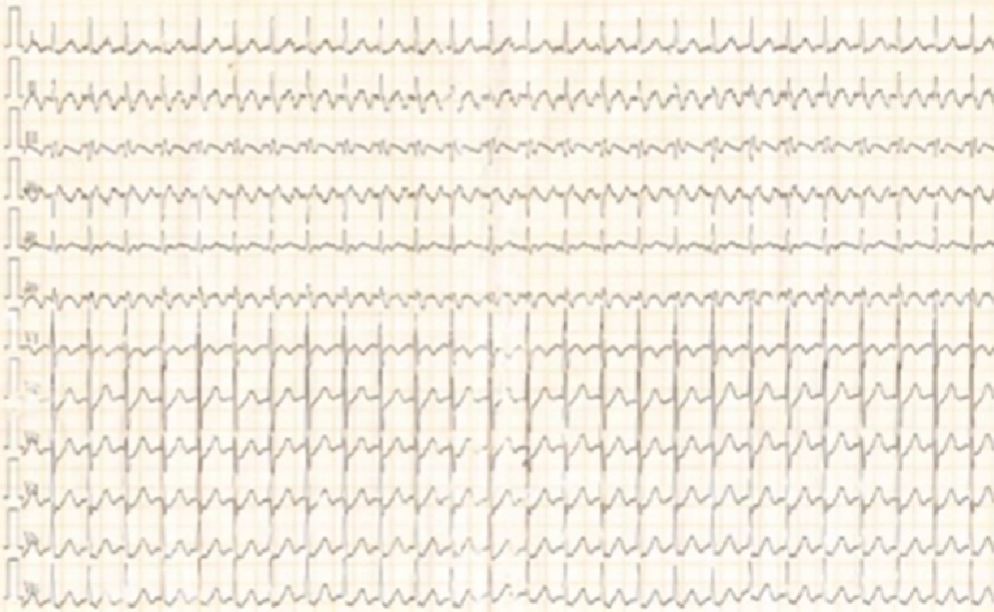 心律失常的诊断与治疗，太全了