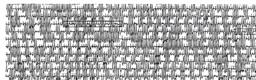 心律失常的诊断与治疗，太全了