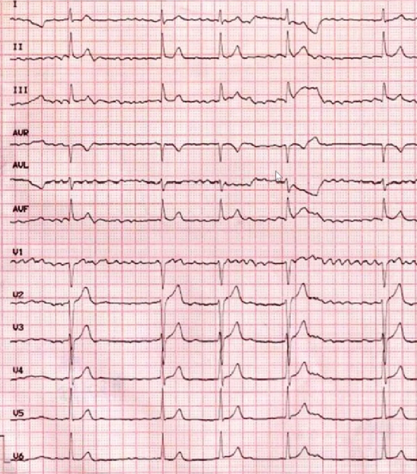 心律失常的诊断与治疗，太全了