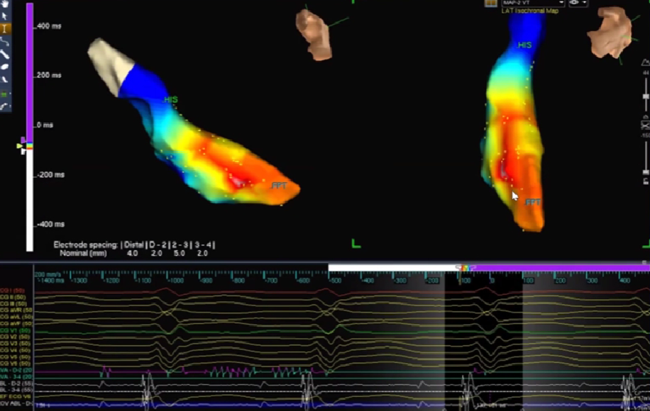 心律失常的诊断与治疗，太全了