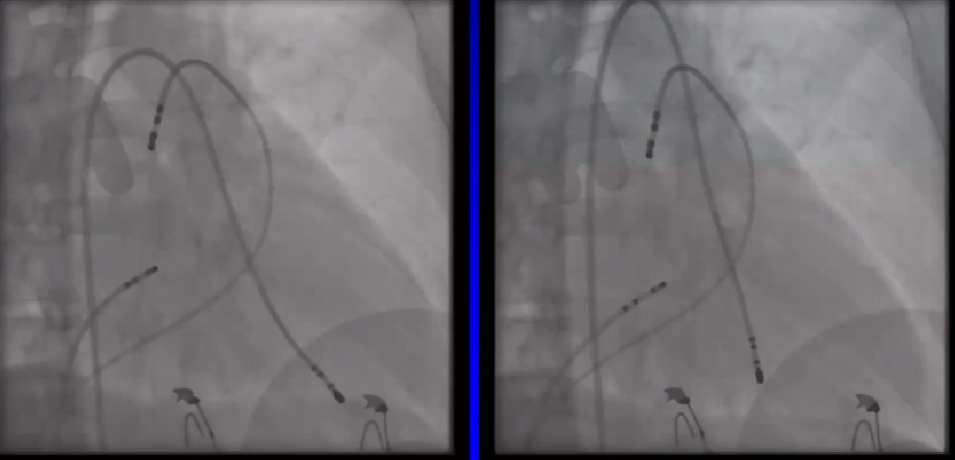 心律失常的诊断与治疗，太全了