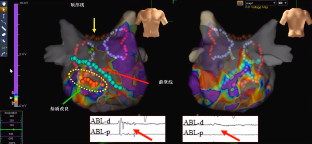 心律失常的诊断与治疗，太全了