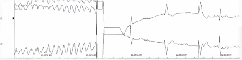 心律解码丨心源性猝死及心脏急救