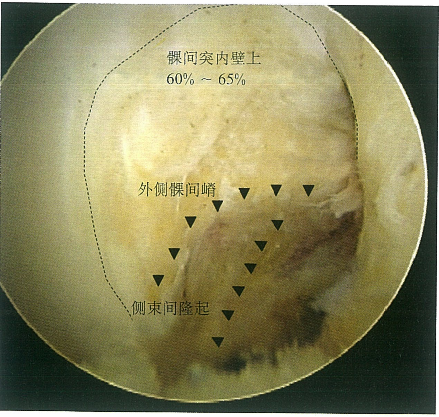 关于自体腘绳肌腱重建前交叉韧带术中细节点都在这里