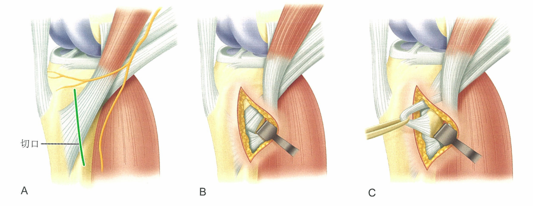 关于自体腘绳肌腱重建前交叉韧带术中细节点都在这里
