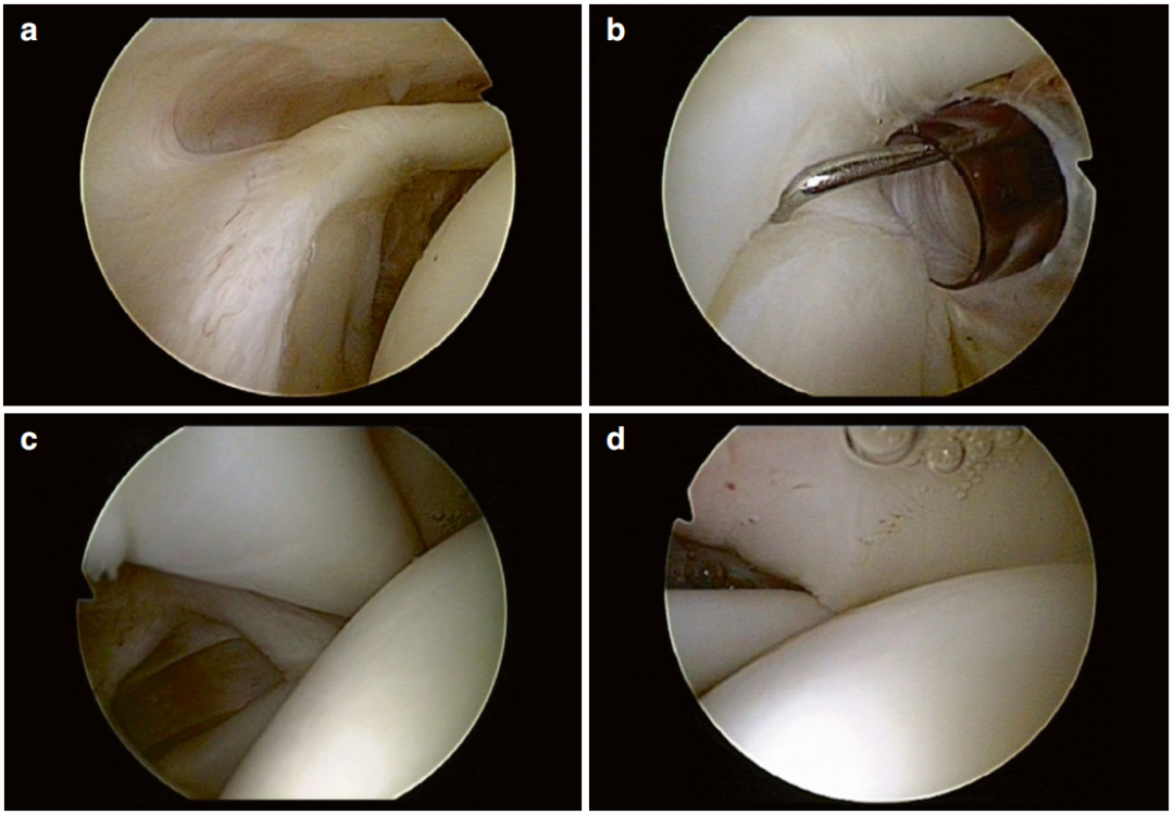 做好一台肩关节镜手术，这些体位、入路选择、诊断检查与滑线结知识一定要掌握！