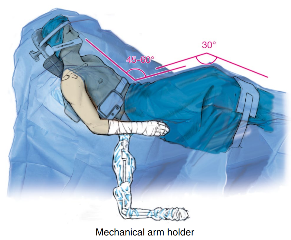 做好一台肩关节镜手术，这些体位、入路选择、诊断检查与滑线结知识一定要掌握！