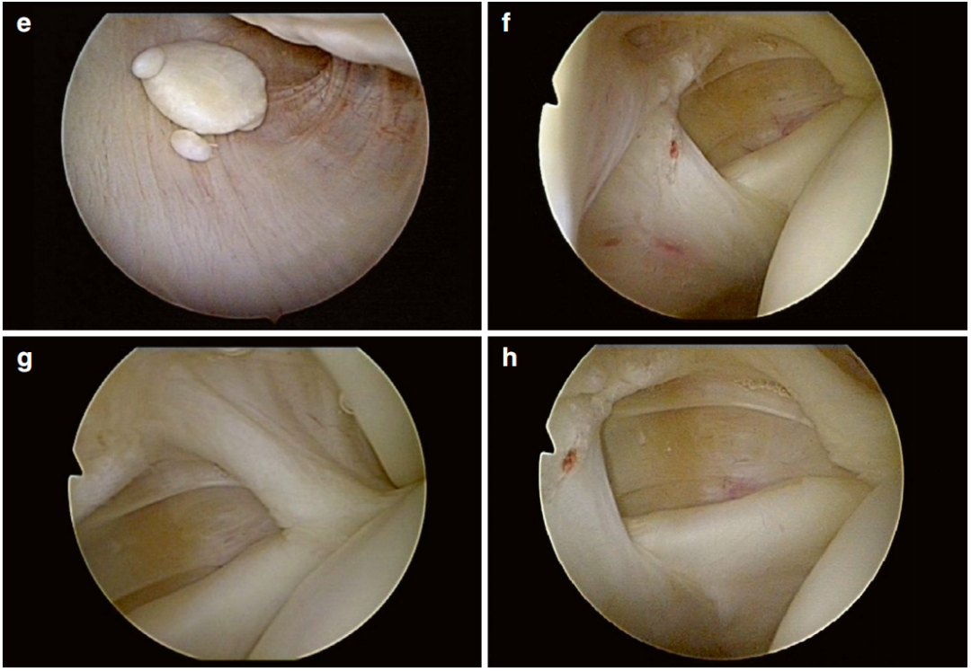 做好一台肩关节镜手术，这些体位、入路选择、诊断检查与滑线结知识一定要掌握！