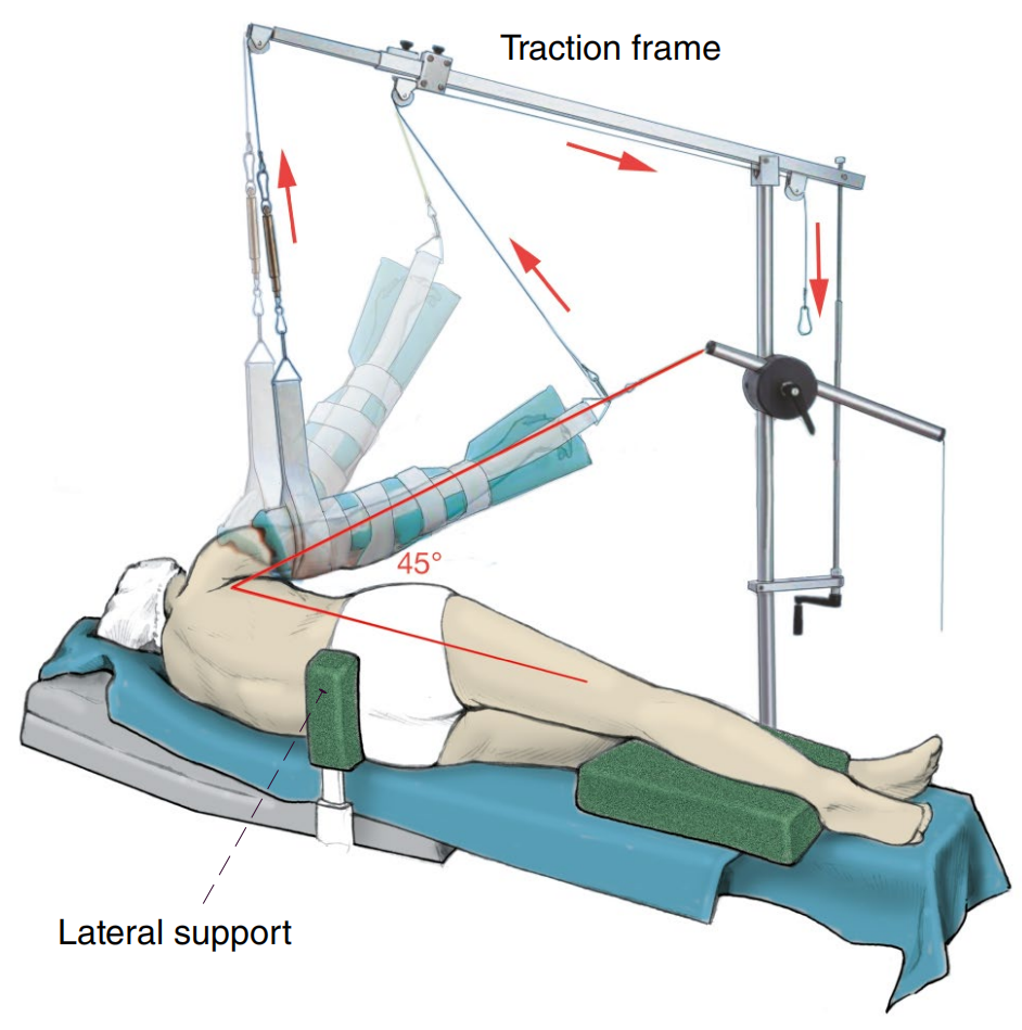 做好一台肩关节镜手术，这些体位、入路选择、诊断检查与滑线结知识一定要掌握！