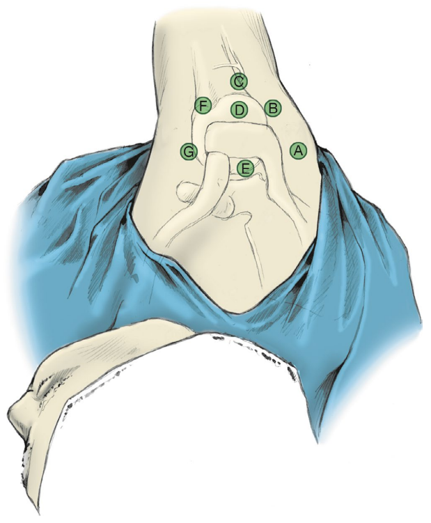 做好一台肩关节镜手术，这些体位、入路选择、诊断检查与滑线结知识一定要掌握！