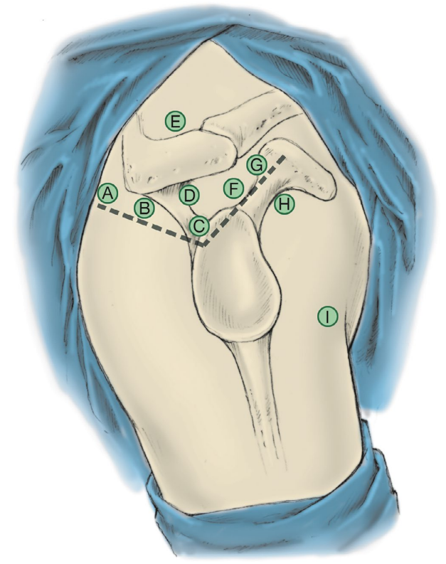 做好一台肩关节镜手术，这些体位、入路选择、诊断检查与滑线结知识一定要掌握！