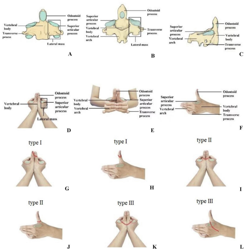 “手足并用”教学法，助你快速掌握常见（脊柱、上肢、下肢）骨折脱位及分类