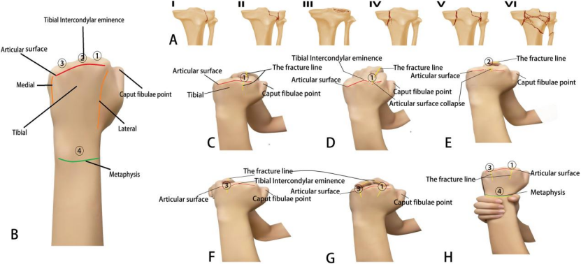 “手足并用”教学法，助你快速掌握常见（脊柱、上肢、下肢）骨折脱位及分类