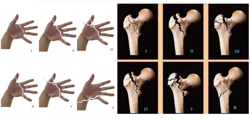 “手足并用”教学法，助你快速掌握常见（脊柱、上肢、下肢）骨折脱位及分类