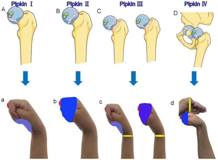 “手足并用”教学法，助你快速掌握常见（脊柱、上肢、下肢）骨折脱位及分类