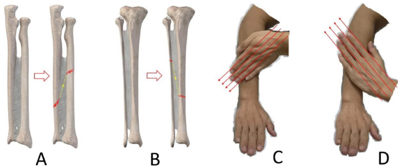 “手足并用”教学法，助你快速掌握常见（脊柱、上肢、下肢）骨折脱位及分类