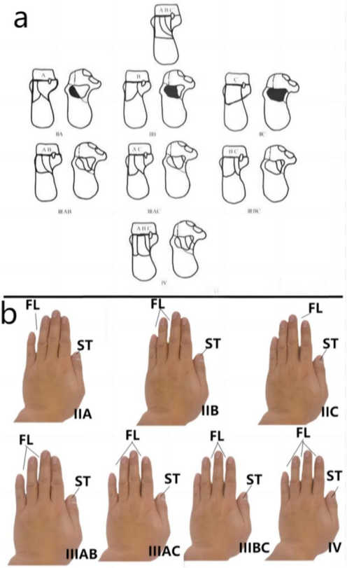 “手足并用”教学法，助你快速掌握常见（脊柱、上肢、下肢）骨折脱位及分类