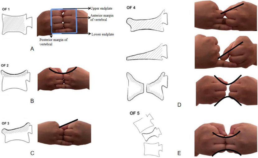 “手足并用”教学法，助你快速掌握常见（脊柱、上肢、下肢）骨折脱位及分类