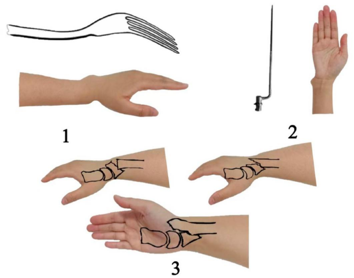 “手足并用”教学法，助你快速掌握常见（脊柱、上肢、下肢）骨折脱位及分类