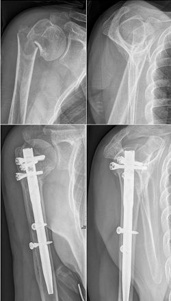 肱骨近端骨折：解剖、分型、治疗及内固定全面讲解！