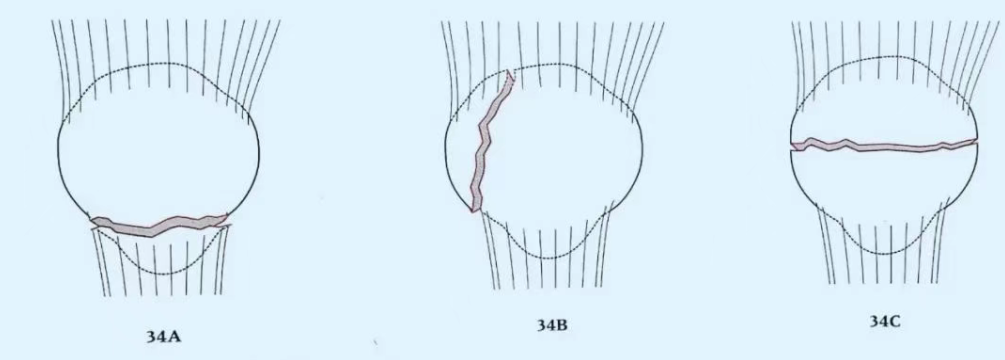 髌骨骨折，微创经皮空心钉的治疗
