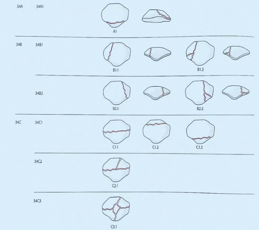 髌骨骨折，微创经皮空心钉的治疗