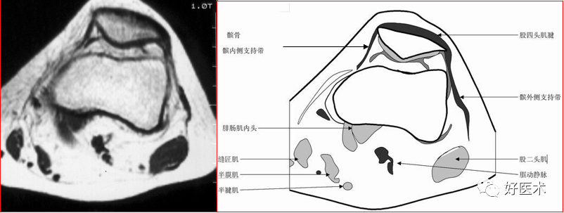 半月裂孔解剖图图片