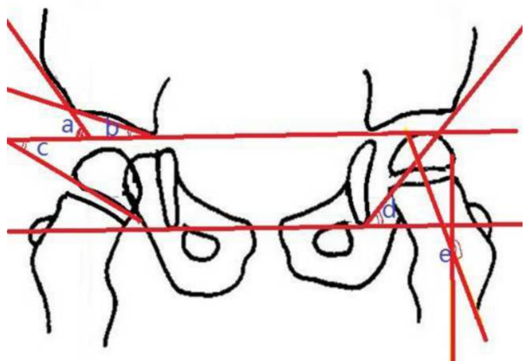 DDH的诊断、分型与治疗原则