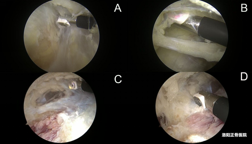 肘关节镜下“精准清理”治疗顽固性肱骨内上髁炎