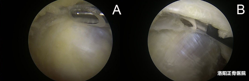 肘关节镜下“精准清理”治疗顽固性肱骨内上髁炎